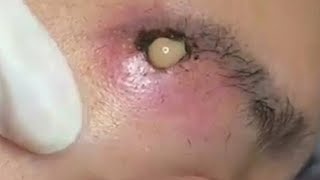 Big Cystic Acne Blackheads Extraction Blackheads amp Milia Whiteheads Removal Pimple Popping 099 [upl. by Sedgewinn]