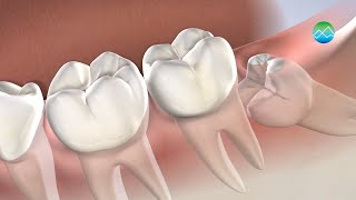 Wisdom Teeth Removal  Kitsap Oral Maxillofacial amp Dental Implant Surgery [upl. by Thanh850]