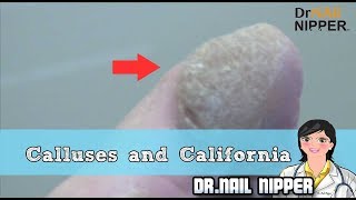 What is a Callus Two Patient Callus and California Callus Tuesday 31 [upl. by Raamal]