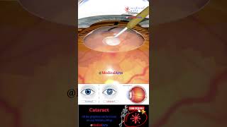 Cataract  Lens Implant  Medical Arts Shorts  3d animation surgery [upl. by Fonville909]