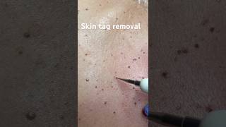 DPNSkin Tag Removal skintags dpnremoval moleremovaltreatment [upl. by Towill]