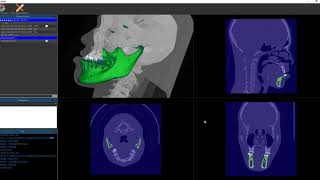 Deep learning based CT Segmentation mandible Demo [upl. by Bree777]