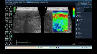 IQ 281 HEPATOMA ECHOPAC ANALYSIS ULTRASOUND ELASTOGRAPHY [upl. by Ssor]