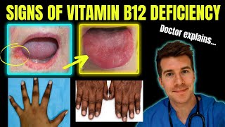 Doctor explains clinical signs of Vitamin B12 cobalamin deficiency  Glossitis mouth ulcers etc [upl. by Mungam]