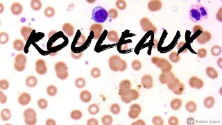 Rouleaux Formation Erythrocytes on Peripheral Blood Smear in Multiple Myeloma Hemepath Hematology [upl. by Agbogla257]