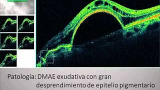 Tomografía de coherencia óptica OCT Casos clínicos [upl. by Ellinger]