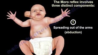 Moro Reflex  Everything You Need To Know  Dr Nabil Ebraheim [upl. by Alikat]