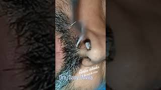 Botfly Maggot Removal spa doctor satisfying pimple removal [upl. by Alywt143]