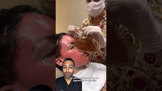 The most EXTREME Chemical Peel 😵 Dr Somji Reacts [upl. by Vania]