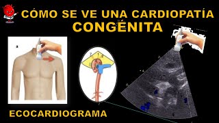 Persistencia del Conducto Arterioso  Ecocardiograma [upl. by Cormac]