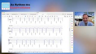 Apprendre à lire un ECG à partir d’un tracé de moniteur cardiaque implantable  Tracés normaux [upl. by Dibb]