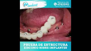 Prueba de Estructura Zirconio sobre implantes [upl. by Rimma]