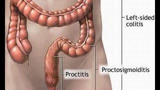 Treatment of Proctitis [upl. by Gibe614]