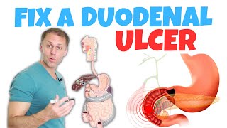 How to Correct a Duodenal Ulcer [upl. by Annelise]