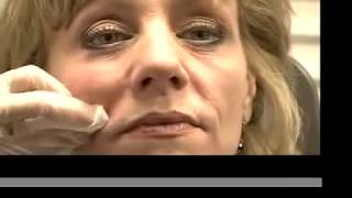 LIQUID FACELIFT  Dermal Filler Cheeks [upl. by Anielram612]