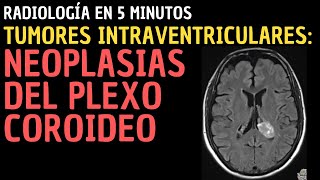 Radiología en 5 minutos Tumores intraventriculares Neoplasias del plexo coroideo [upl. by Kaila]