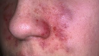 Eczema Dermatitis Treatment  The Benefits of Treating Eczema with Home Remedies [upl. by Dlorad545]