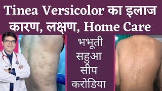 Top 10 Herbs and Home Remedies for Tinea Versicolor  Natural Treatment shorts [upl. by Omland263]