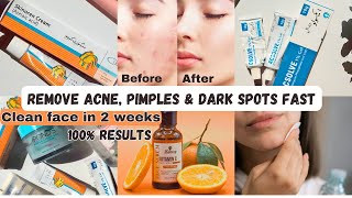 REMOVE ACNE PIMPLES AND DARK SPOTS FAST [upl. by Lesko]