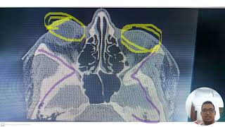 tomografía de orbitas [upl. by Niemad]