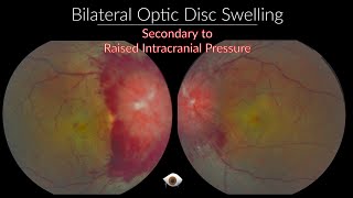 Papilloedema  Optic Nerve swelling [upl. by Nonnac]