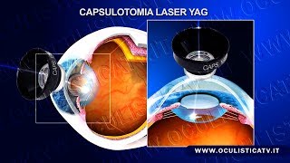 Cataratta secondaria capsulotomia laser YAG [upl. by Hobard]