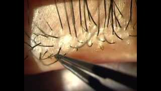 Demodex Blepharitis  Is it for real [upl. by Saxen]