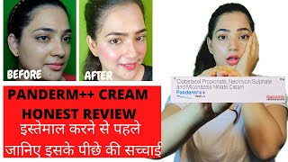 Panderm cream review  Panderm plus lagane se kya hota hai  penderm [upl. by Sivrahc638]