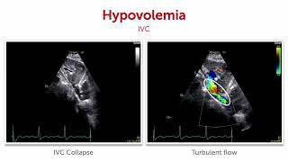 What does abnormal collapsibility of the IVC look like [upl. by Jevon636]