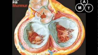 Aortic Regurgitation Murmur [upl. by Alessandra167]