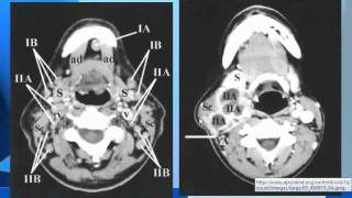 Radiology  Cervical Lymph Nodes  Head and Neck [upl. by Ezzo]