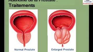 Traitements de Adénome de la prostate [upl. by Eanel]