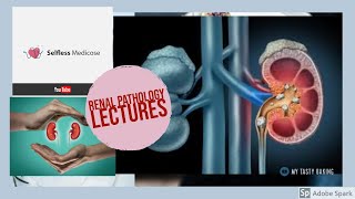 RENAL PATHOLOGY lecture 20 CYSTIC DISEASES OF KIDNEY simple cyst [upl. by Nudnarb]