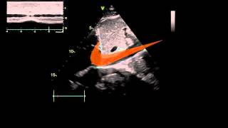 7 minutes IVC ultrasound part 1 [upl. by Tybalt]