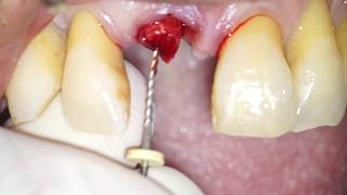 Atraumatic Root Extraction by means of an endodontic file  Dr Fabio Cozzolino [upl. by Tandie]