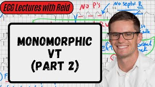 Monomorphic VT Part 2  Day 22 ECG Challenge [upl. by Anaerdna]