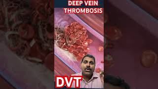 Deep vein thrombosis [upl. by Sidoma]