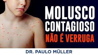 Molusco Contagioso – Verrugas em Crianças – Dr Paulo Müller Dermatologista [upl. by Alleber247]