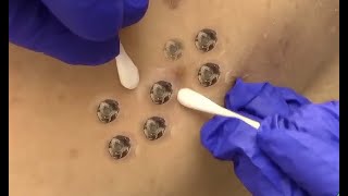 Extreme Blackhead Extraction From Back [upl. by Fording]