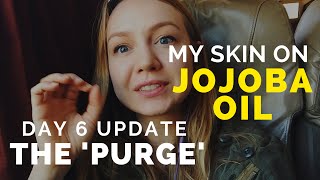 Jojoba Oil On AcneProne Skin Day 6 Purge [upl. by Ahsirpac985]