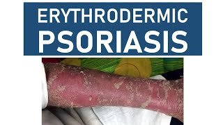 Erythrodermic Psoriasis [upl. by Aicele]