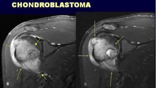 Radiographic Approach to Bone Lesions Part II [upl. by Orutra]