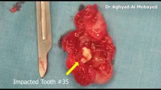 Dr Aghyad  Dentigerous cyst of mandible  excisional biopsy [upl. by Yliah]