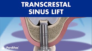 TRANSCRESTAL sinus lift  IMPLANT placement for BONELESS patients © [upl. by Tailor]