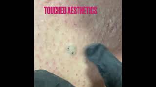 Episode 2 ingrown hair extractions [upl. by Petuu364]