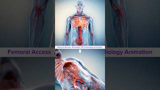 Femoral Access to Cardiac Chamber Cardiac Catheterization Procedure Animation3D Cardiology Animation [upl. by Zilef]