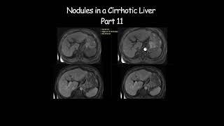 Nodules in a Cirrhotic Liver  Part 11 radiology radiologist cirrhosis liverdisease liverhealth [upl. by Pinter]