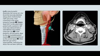 Branchial cystㅣthyroglossal cystㅣthornwaldt cyst radiology [upl. by Polinski]