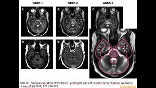 45 Osmotic demyelination syndrome ODS pontine myelinolysis hyponatriemia correction piglet sign [upl. by Atsahs536]