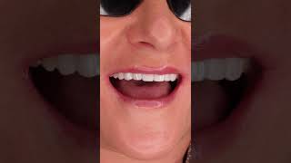 What do Porcelain Veneers look like veneers porcelainveneers dentalmakeover [upl. by Finstad]